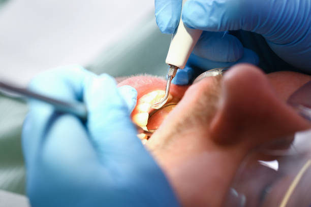 Best Emergency Tooth Extraction in Huntsville, TN