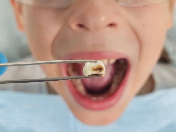 Best Emergency Treatment for Toothache in Huntsville, TN